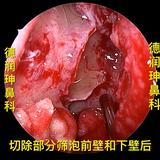 慢性鼻窦炎鼻息肉导致的鼻源性头痛